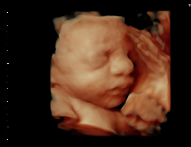 3D ultrasound image at 31 weeks